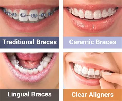 metal or ceramic brackets|are ceramic braces more expensive.